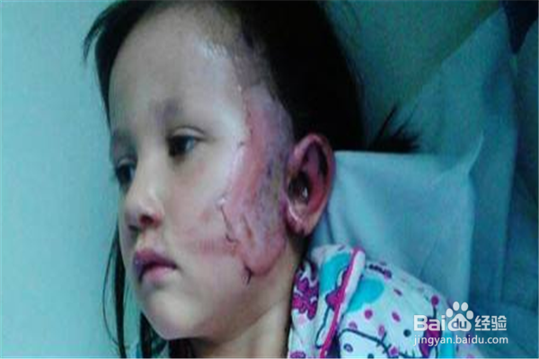 手被烟花烧疼了怎么最快好