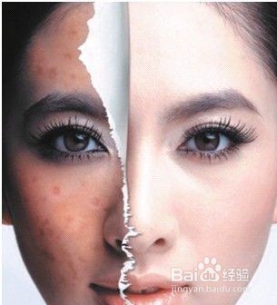 总是长痘痘怎么办