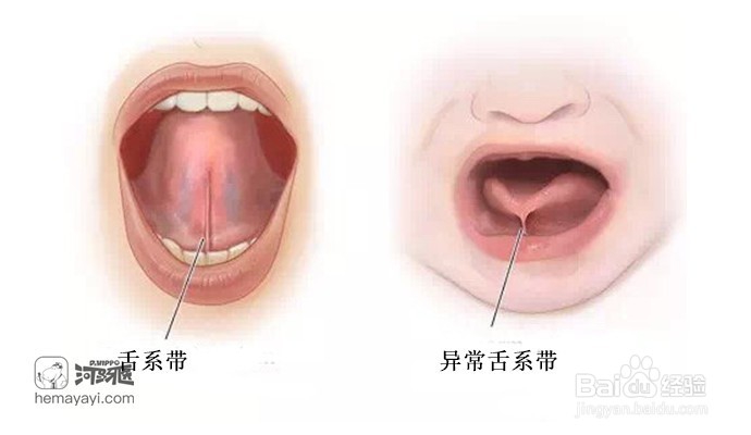 什么是舌系带过短，宝宝何时适合进行舌系带手术