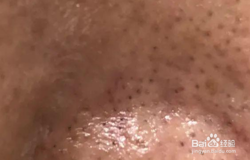 闭口粉刺如何快速消掉