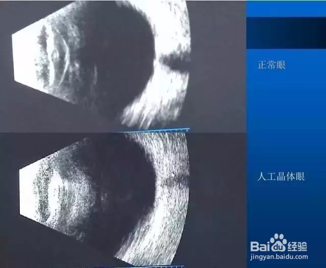 几种常见眼病B超图谱及诊断
