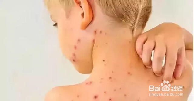 孩子得了水痘在家怎么护理