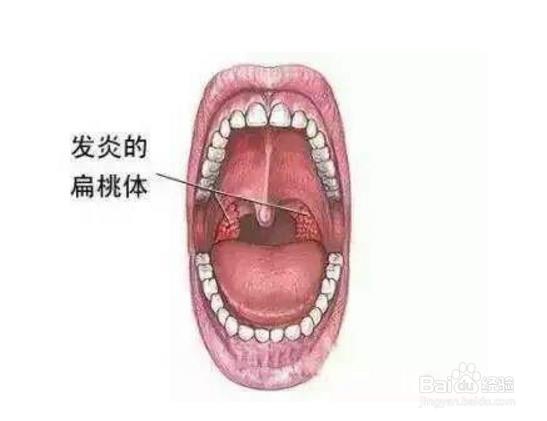 小儿扁桃体发炎吃什么药好得快？