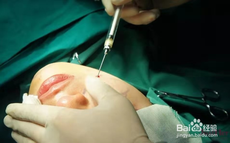 做脂肪二次填充如何提高脂肪填充第二次成活率?