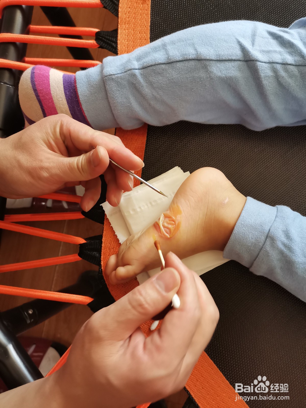 如何挑破脚上的大水泡