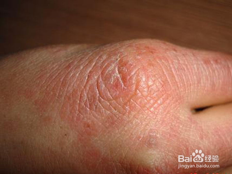 冬季手长冻疮了怎么办？