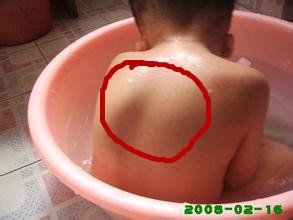 小孩突发高烧怎么办