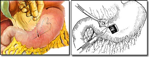 十二指肠溃疡四大危害