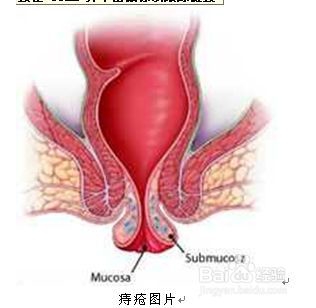 痔疮是什么样的