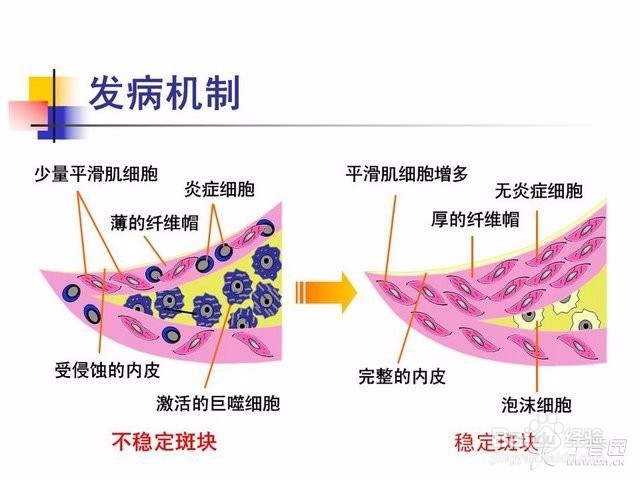 冠状动脉粥样硬化性心脏病的用药指导