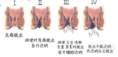 痔疮如何避免开刀