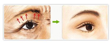 最好的除皱纹方法：[3]上眼睑除皱效果如何