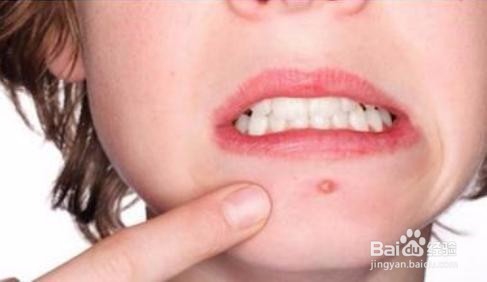 男生祛痘的日常方法！