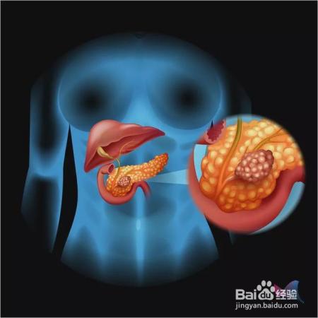 它是癌中之王!最致命、难发现、扩散快!出现这些症状要当心
