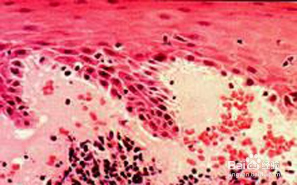 扁平苔藓症状哪些较常见