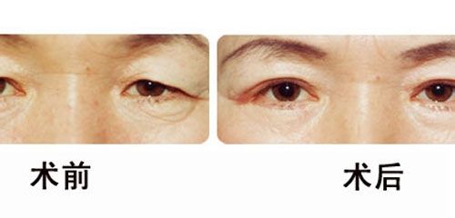 上睑下垂矫正术