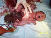 如何预防胎儿先天性畸形