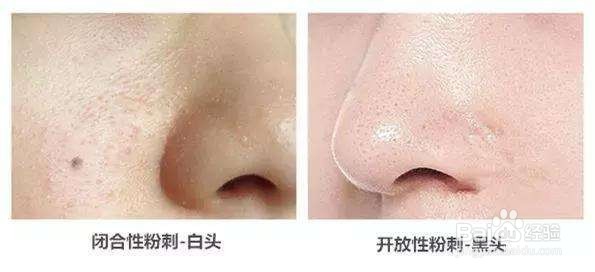 去黑头的方法都有哪些