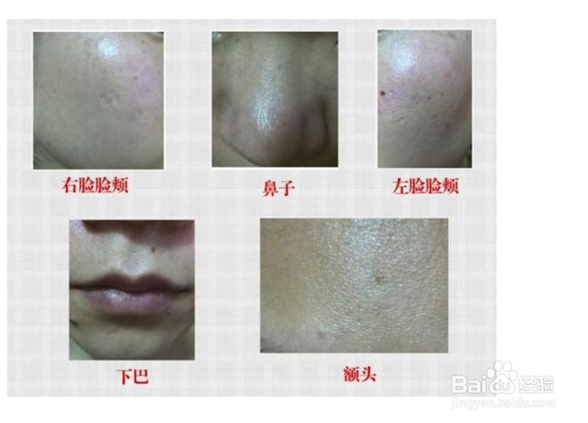 油性皮肤毛孔粗大怎么办