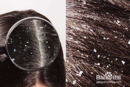 百度经验--如何去除头皮屑的困扰