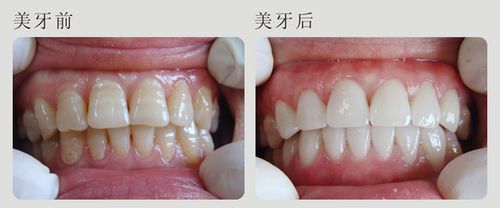 牙齿不白有什么方法美白?
