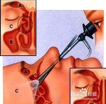 鼻息肉的治疗方法