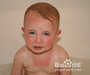 宝宝晒伤之后该怎么办?
