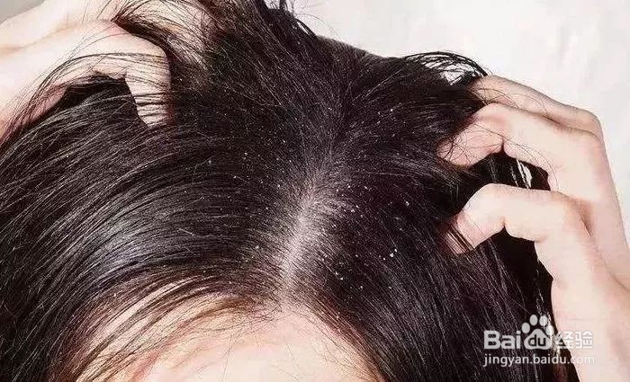 硫磺洗发水作用与功效