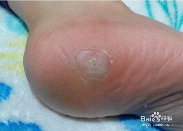 得了脚气怎么办？