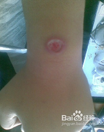 教你如何去除烟疤