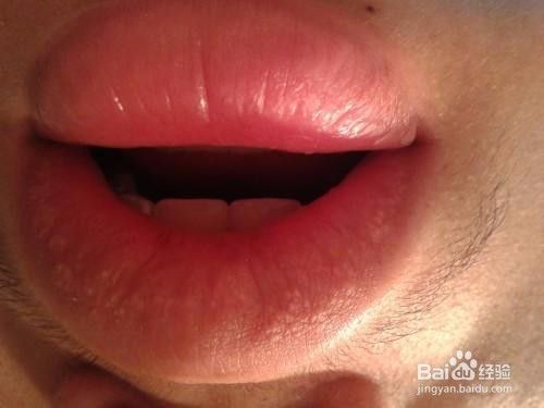 嘴唇起疱疹怎么办 又疼又难看 百度经验