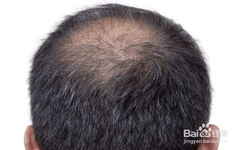 如何做到防止脱发？