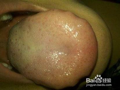 这几个特征说明你体内湿热较重