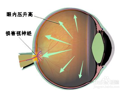 视神经萎缩康复病例