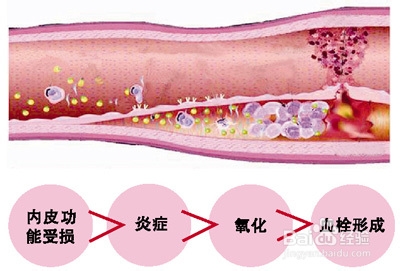 高血压与冠心病的渊源