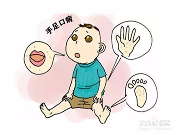 <b>孩子得了手足口病怎么护理</b>