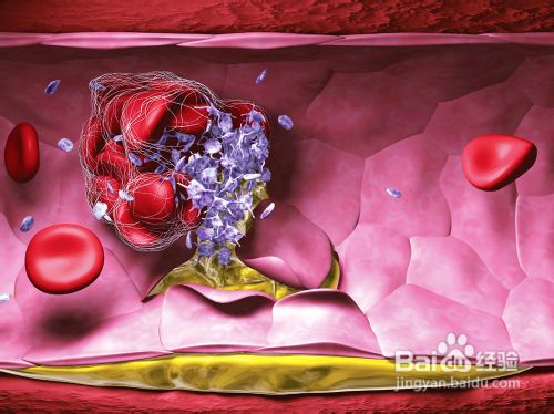 关注健康 血小板增多症的症状有哪些