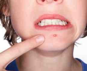 祛痘的成分有哪些?