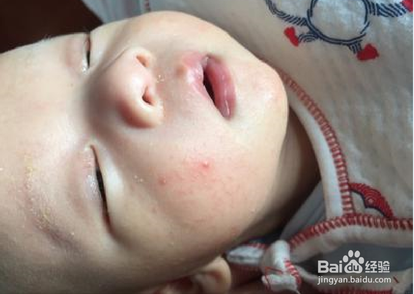 <b>一个月的宝宝脸上长了湿疹怎么办</b>
