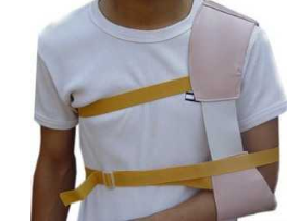 肩部脱臼临时固定方法