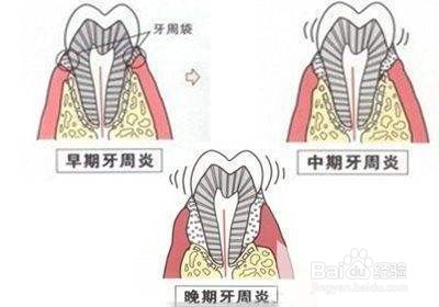 糖尿病口臭会有并发症？白背三七诺丽果粉告诉你