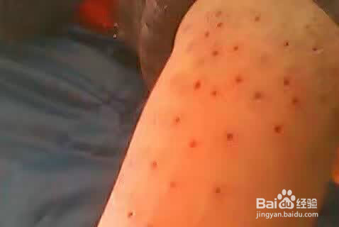 用火炙来缓解治疗骨病(风湿类风湿痛风腰痛)