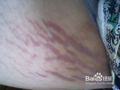 兰雅祛纹精油的使用方法