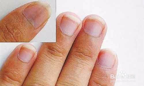 手上出现密密麻麻的小水泡怎么办