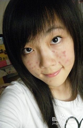 预防青春痘需如何饮食呢?