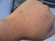 小孩长扁平忧怎么办