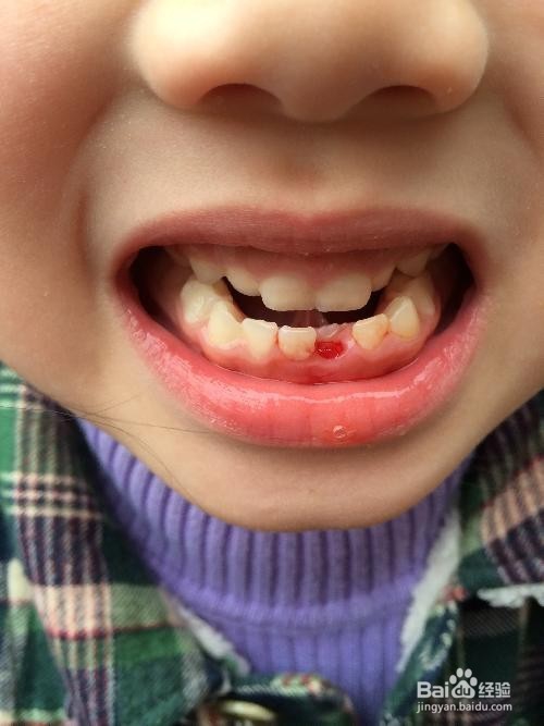 儿童乳牙还没掉恒牙就长出来了怎么办？