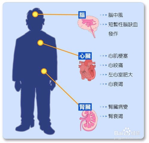 高血压可以私自停药吗