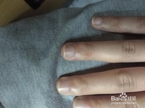 手指甲有点泛白是什么原因