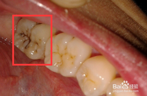 黑色龋齿怎么自己去除